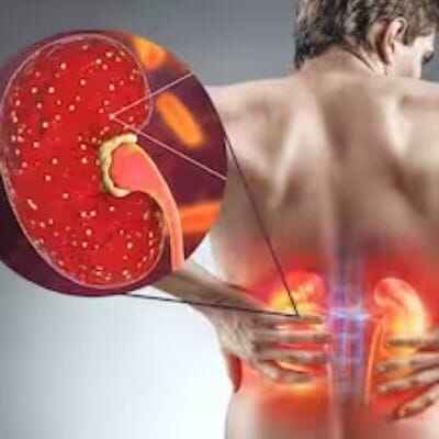 ayurvedic kidney treatment