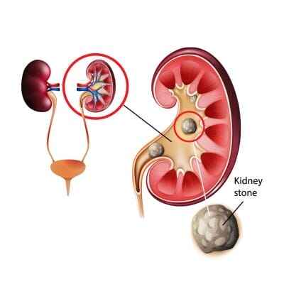 natural kidney treatment